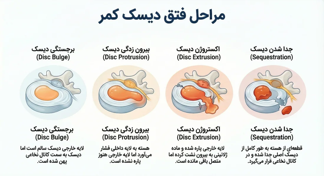 دیسک کمر چیست؟